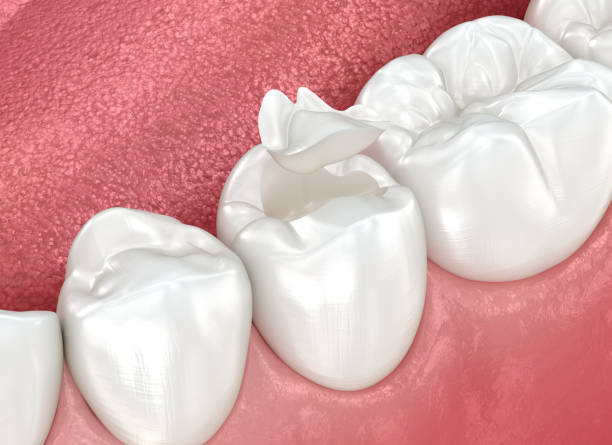 Best Dental Inlays and Onlays  in Bottineau, ND